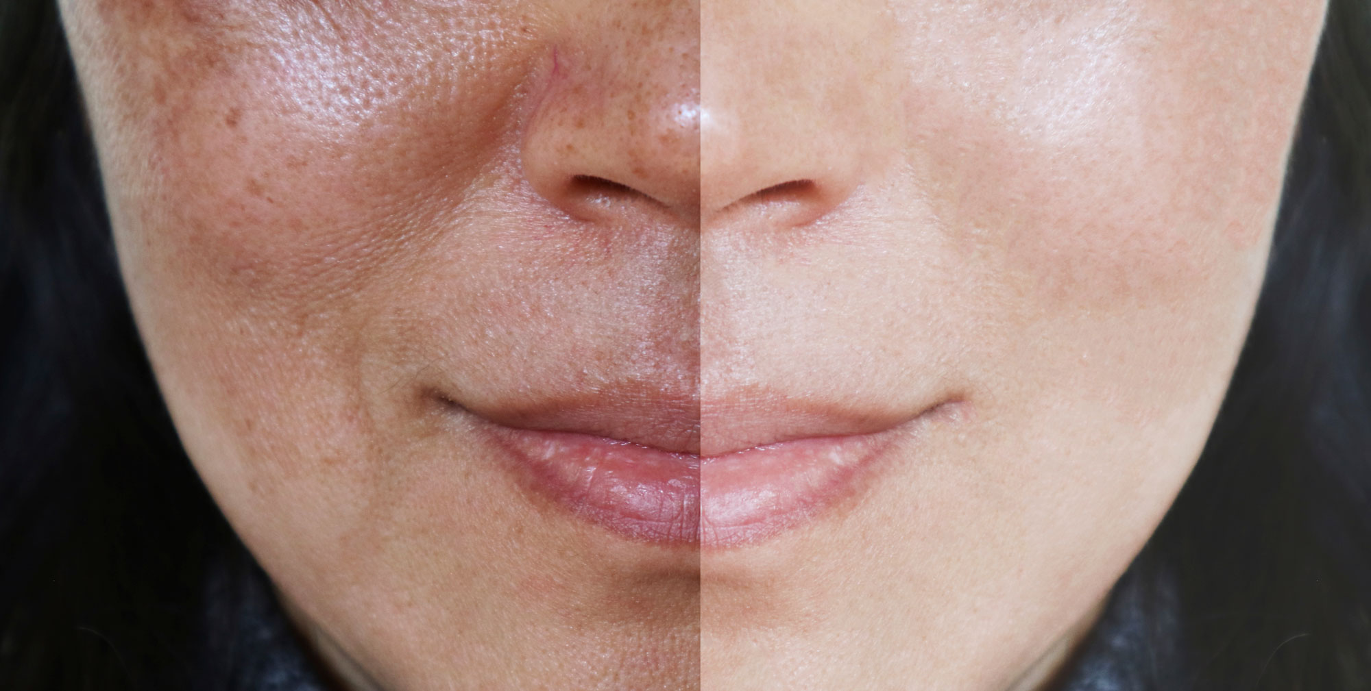 pigmentation-and-melasma-q-dermatology