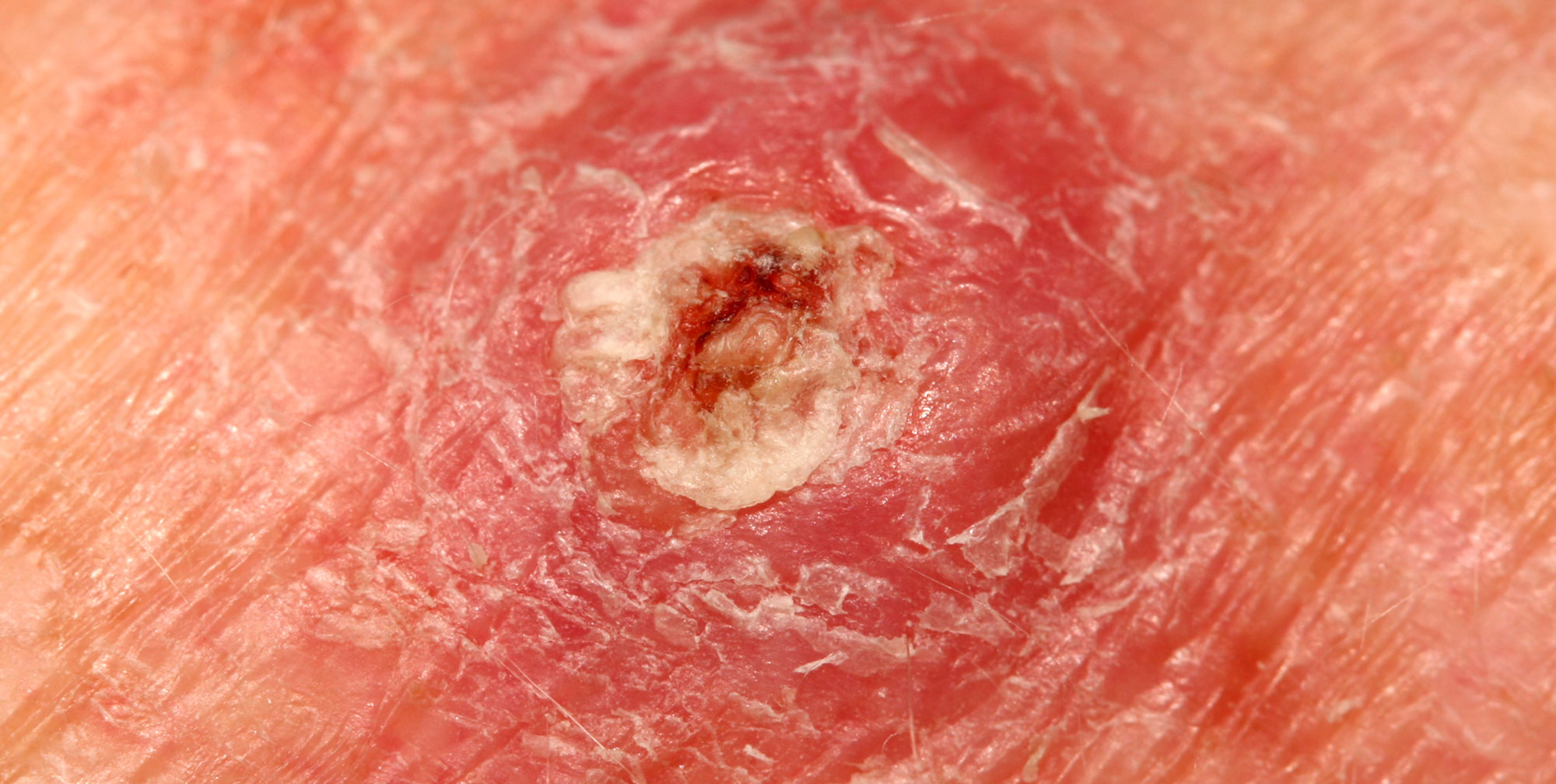 Squamous Cell Carcinoma | Q Dermatology